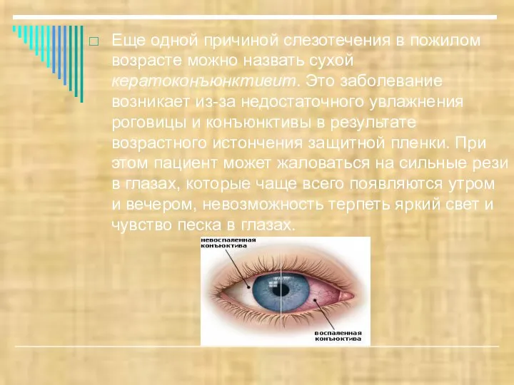 Еще одной причиной слезотечения в пожилом возрасте можно назвать сухой кератоконъюнктивит.