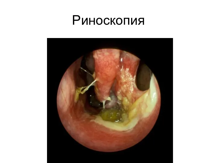 Риноскопия