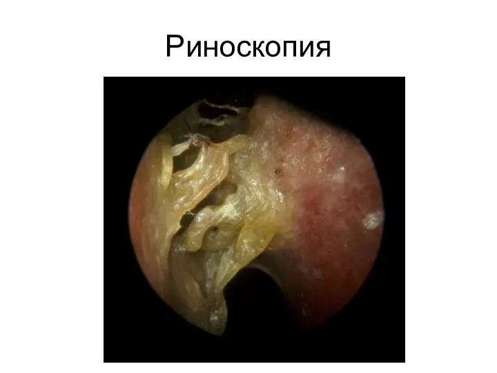 Риноскопия