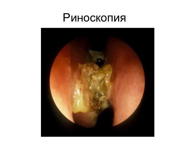 Риноскопия