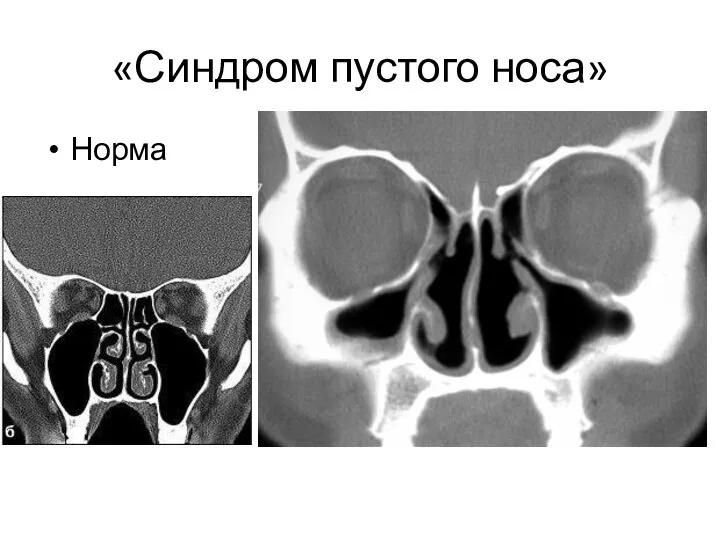 «Синдром пустого носа» Норма