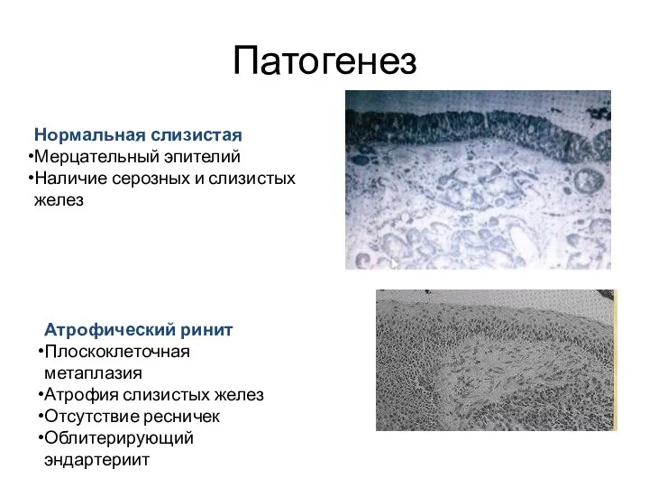 Патогенез Нормальная слизистая Мерцательный эпителий Наличие серозных и слизистых желез Атрофический