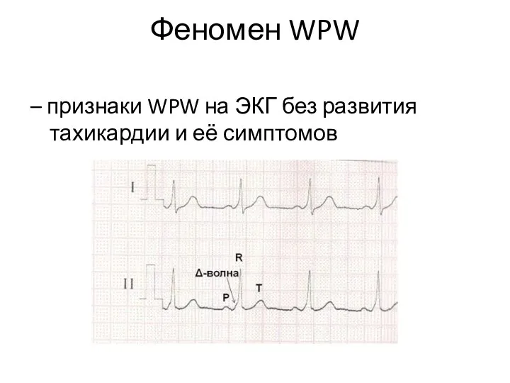 Феномен WPW – признаки WPW на ЭКГ без развития тахикардии и её симптомов