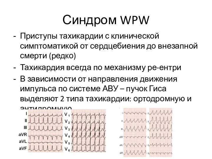 Синдром WPW Приступы тахикардии с клинической симптоматикой от сердцебиения до внезапной