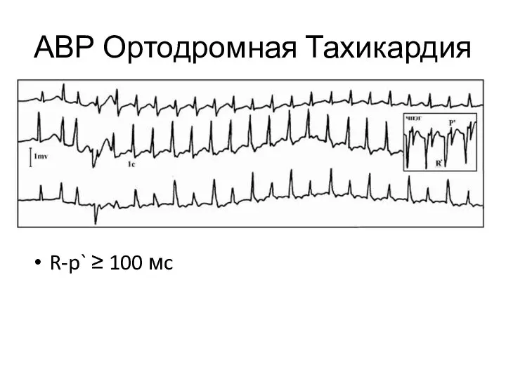 АВР Ортодромная Тахикардия R-p` ≥ 100 мc