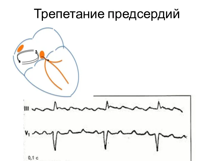 Трепетание предсердий