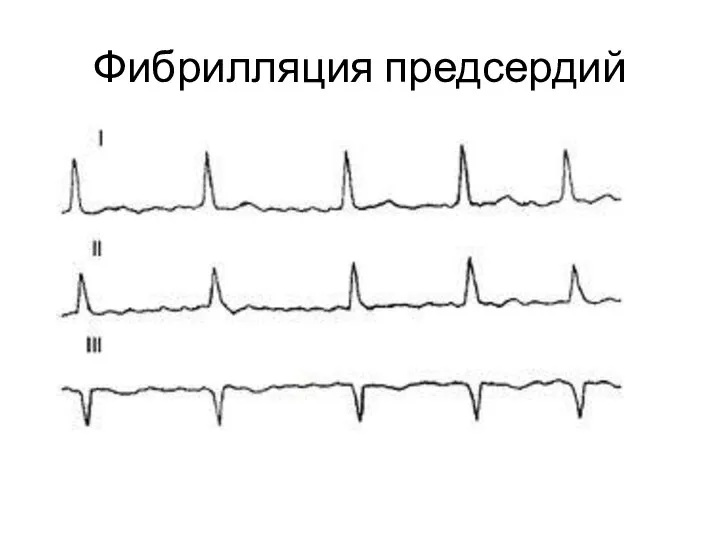 Фибрилляция предсердий