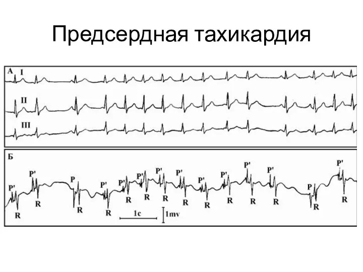 Предсердная тахикардия