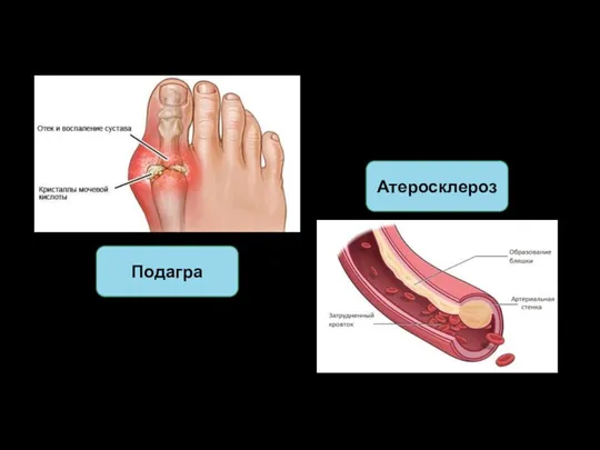Подагра Атеросклероз