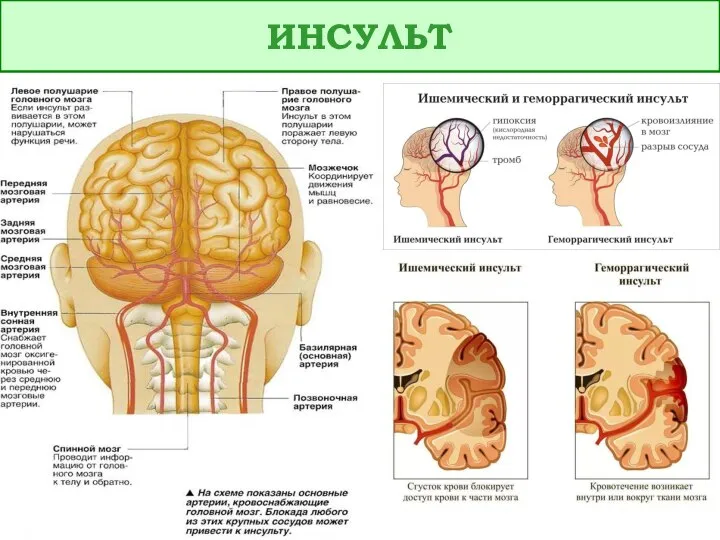 ИНСУЛЬТ