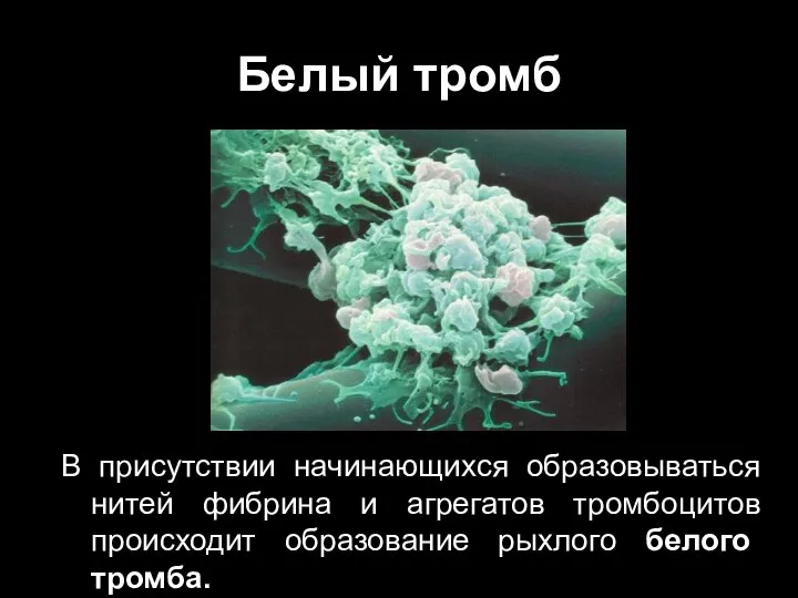 Белый тромб В присутствии начинающихся образовываться нитей фибрина и агрегатов тромбоцитов происходит образование рыхлого белого тромба.