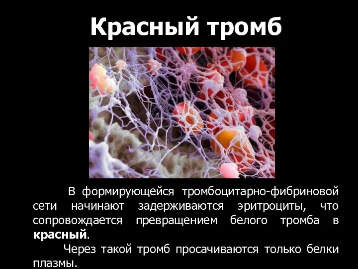 В формирующейся тромбоцитарно-фибриновой сети начинают задерживаются эритроциты, что сопровождается превращением белого