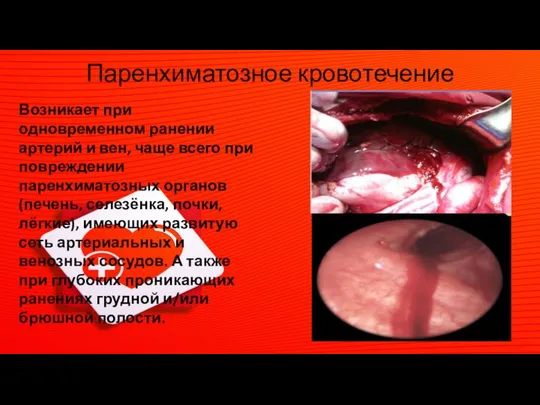 Паренхиматозное кровотечение Возникает при одновременном ранении артерий и вен, чаще всего