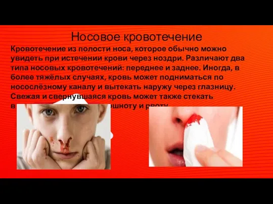 Носовое кровотечение Кровотечение из полости носа, которое обычно можно увидеть при