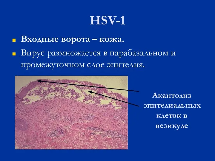 HSV-1 Входные ворота – кожа. Вирус размножается в парабазальном и промежуточном