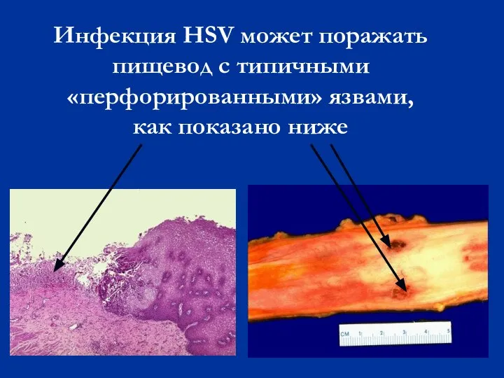 Инфекция HSV может поражать пищевод с типичными «перфорированными» язвами, как показано ниже