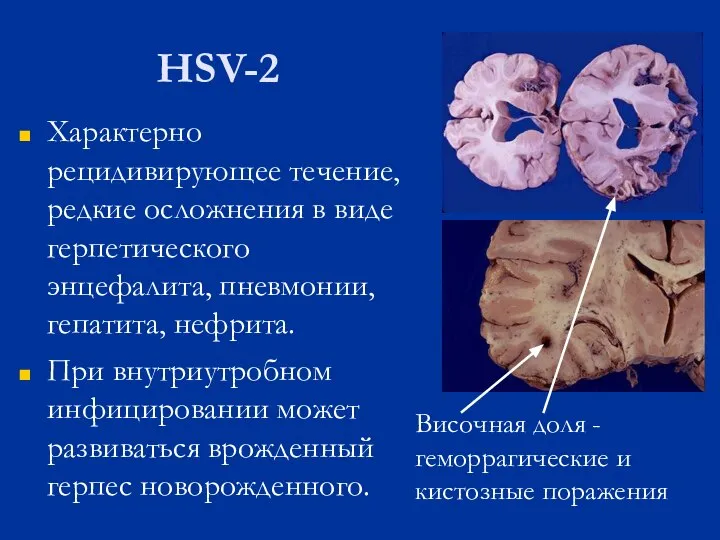 HSV-2 Характерно рецидивирующее течение, редкие осложнения в виде герпетического энцефалита, пневмонии,