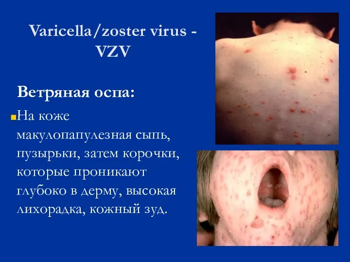 Varicella/zoster virus - VZV Ветряная оспа: На коже макулопапулезная сыпь, пузырьки,