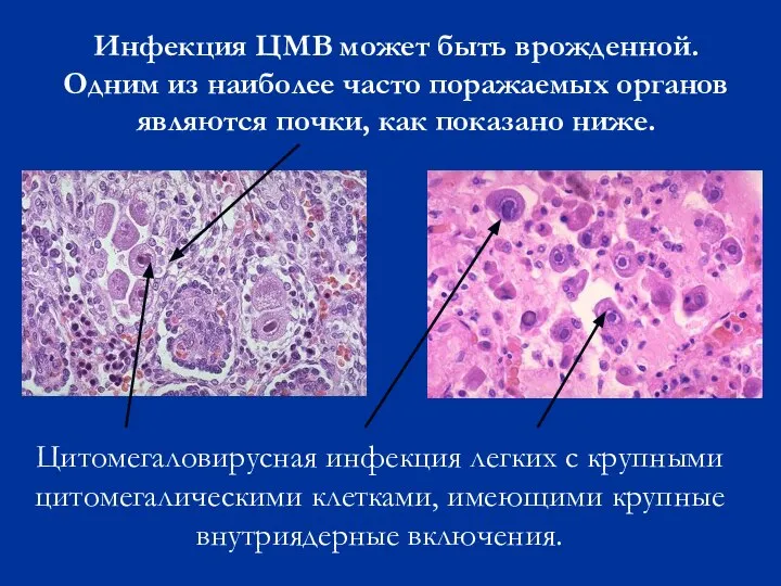 Инфекция ЦМВ может быть врожденной. Одним из наиболее часто поражаемых органов