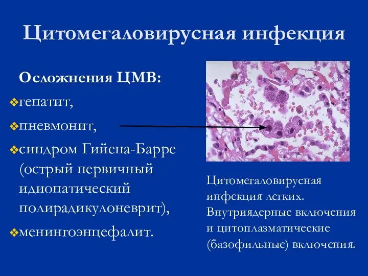 Цитомегаловирусная инфекция Осложнения ЦМВ: гепатит, пневмонит, синдром Гийена-Барре (острый первичный идиопатический