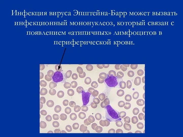 Инфекция вируса Эпштейна-Барр может вызвать инфекционный мононуклеоз, который связан с появлением «атипичных» лимфоцитов в периферической крови.