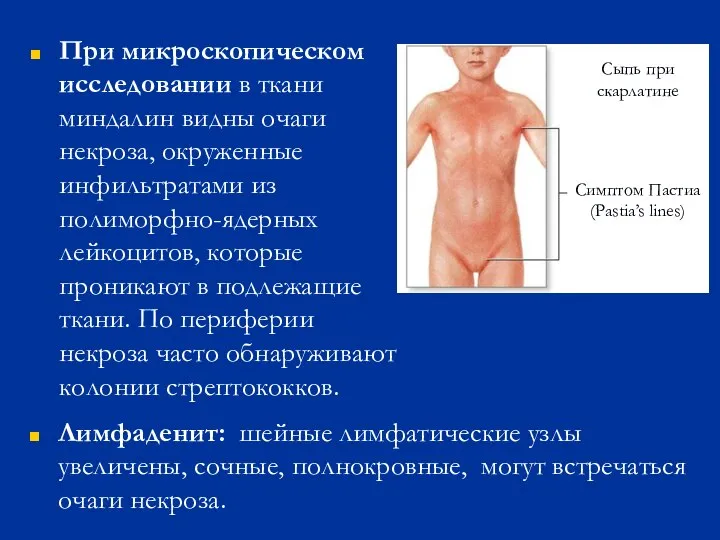 При микроскопическом исследовании в ткани миндалин видны очаги некроза, окруженные инфильтратами