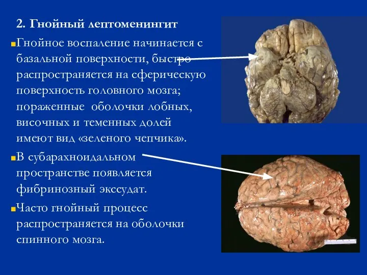 2. Гнойный лептоменингит Гнойное воспаление начинается с базальной поверхности, быстро распространяется