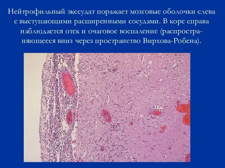Нейтрофильный экссудат поражает мозговые оболочки слева с выступающими расширенными сосудами. В