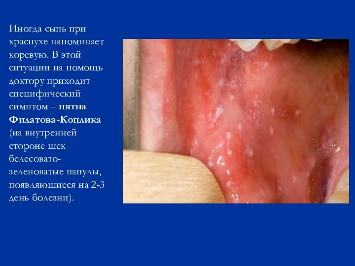 Иногда сыпь при краснухе напоминает коревую. В этой ситуации на помощь