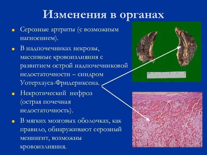 Изменения в органах Серозные артриты (с возможным нагноением). В надпочечниках некрозы,