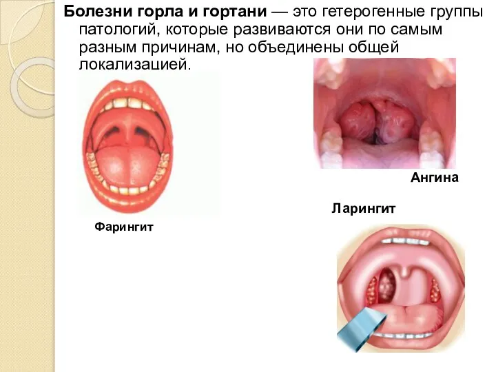 Болезни горла и гортани — это гетерогенные группы патологий, которые развиваются