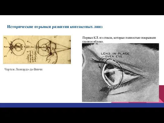 Исторические отрывки развития контактных линз Чертеж Леонардо-да-Винчи Первые КЛ. из стекла, которые полностью покрывали глазное яблоко.