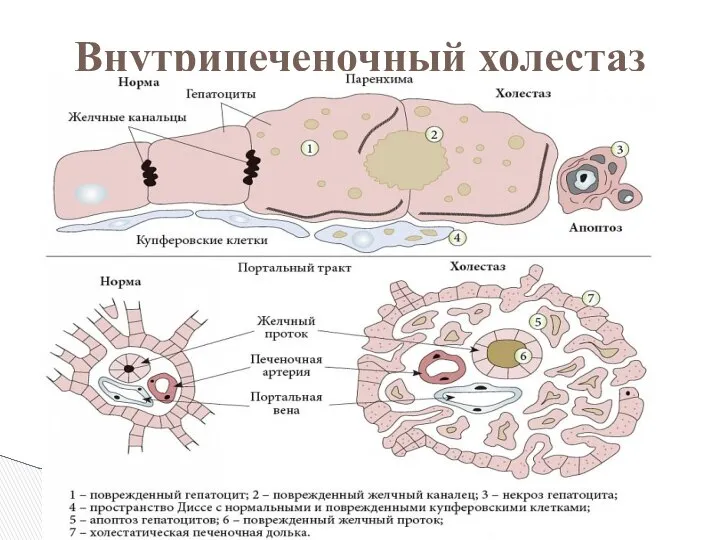 Внутрипеченочный холестаз