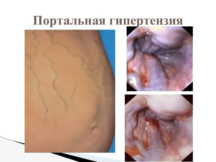 Портальная гипертензия