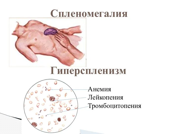 Спленомегалия Гиперспленизм Анемия Лейкопения Тромбоцитопения