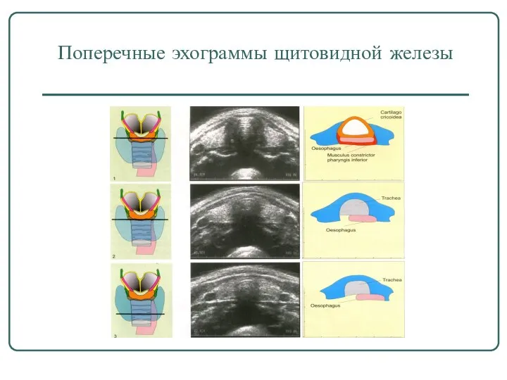 Поперечные эхограммы щитовидной железы