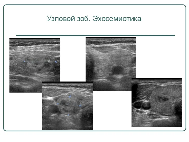 Узловой зоб. Эхосемиотика