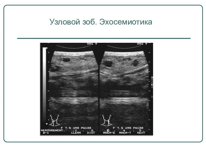 Узловой зоб Узловой зоб. Эхосемиотика