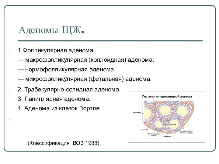 Аденомы ЩЖ. 1.Фолликулярная аденома: — макрофолликулярная (коллоидная) аденома; — нормофолликулярная аденома;