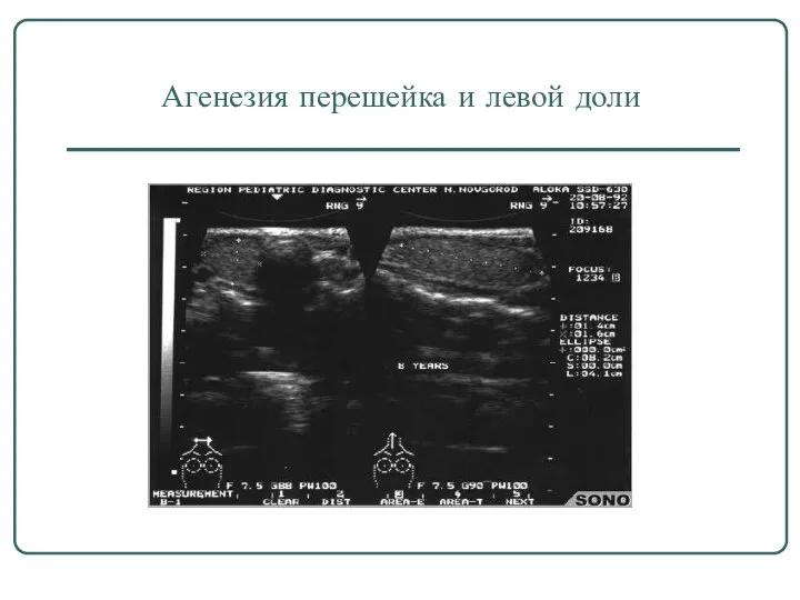 Агенезия перешейка и левой доли