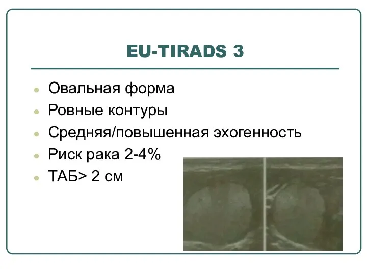 EU-TIRADS 3 Овальная форма Ровные контуры Средняя/повышенная эхогенность Риск рака 2-4% ТАБ> 2 см