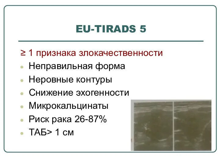 EU-TIRADS 5 ≥ 1 признака злокачественности Неправильная форма Неровные контуры Снижение