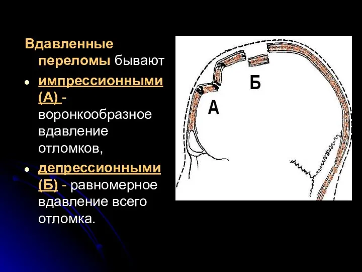 Вдавленные переломы бывают импрессионными (А) - воронкообразное вдавление отломков, депрессионными (Б) - равномерное вдавление всего отломка.