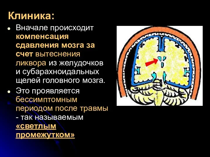 Клиника: Вначале происходит компенсация сдавления мозга за счет вытеснения ликвора из