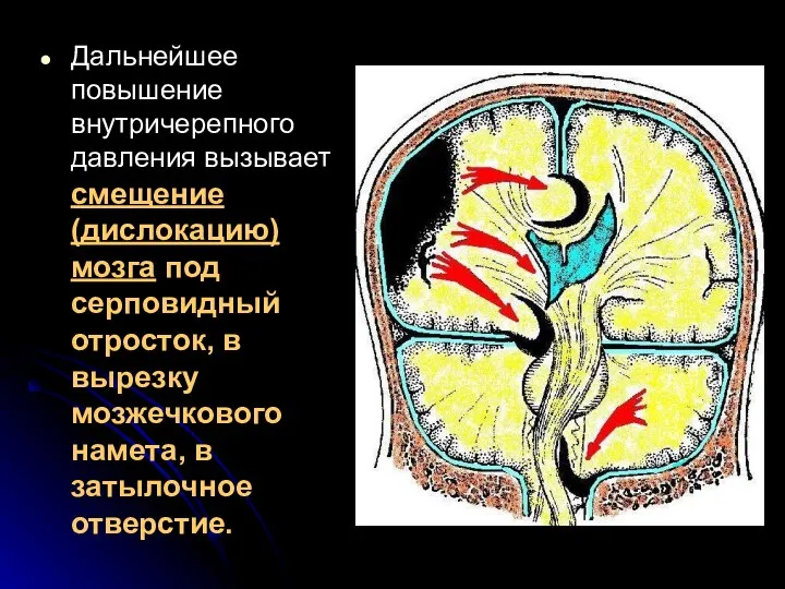 Дальнейшее повышение внутричерепного давления вызывает смещение (дислокацию) мозга под серповидный отросток,