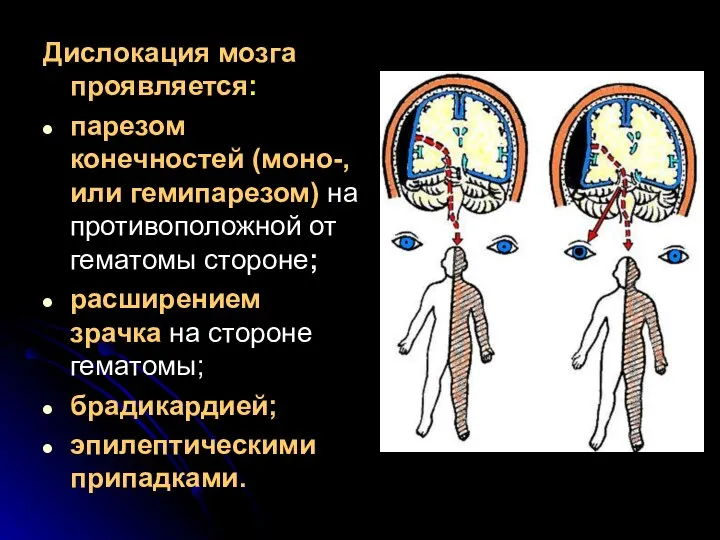 Дислокация мозга проявляется: парезом конечностей (моно-, или гемипарезом) на противоположной от