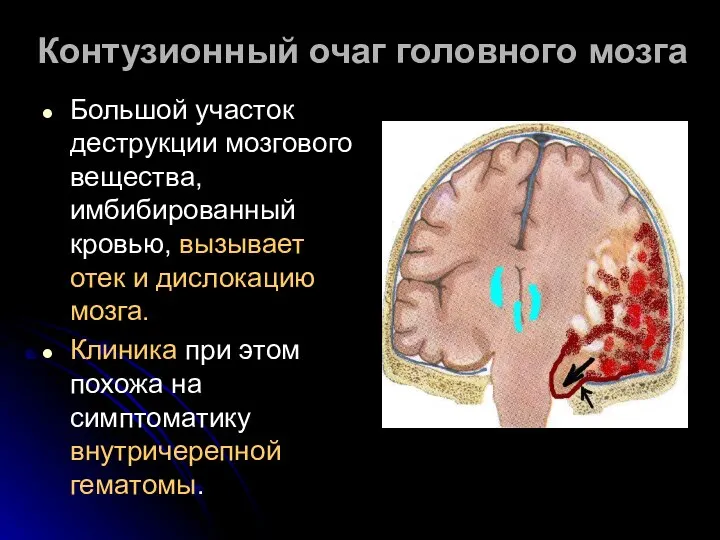 Контузионный очаг головного мозга Большой участок деструкции мозгового вещества, имбибированный кровью,