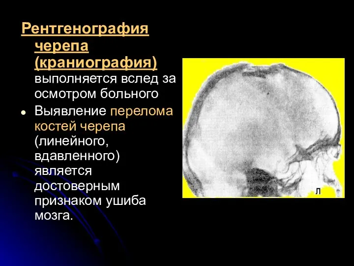 Рентгенография черепа (краниография) выполняется вслед за осмотром больного Выявление перелома костей