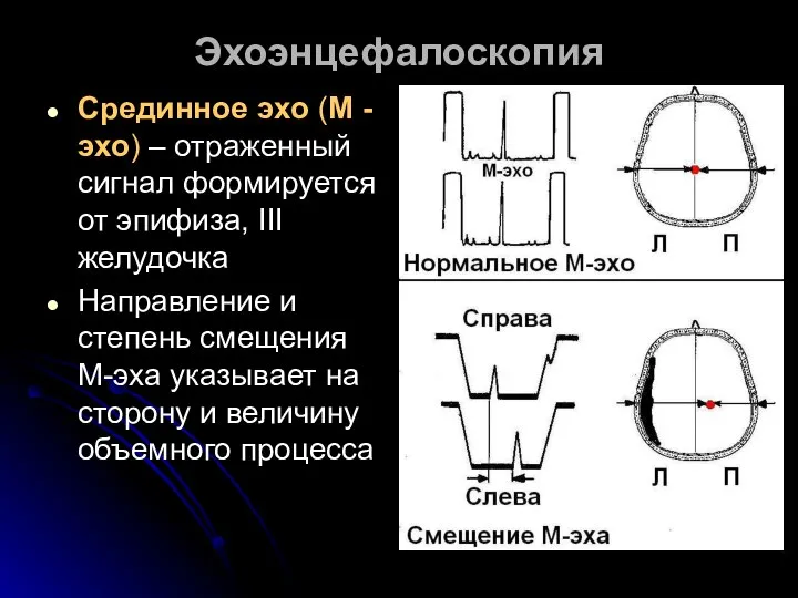 Эхоэнцефалоскопия Срединное эхо (М - эхо) – отраженный сигнал формируется от