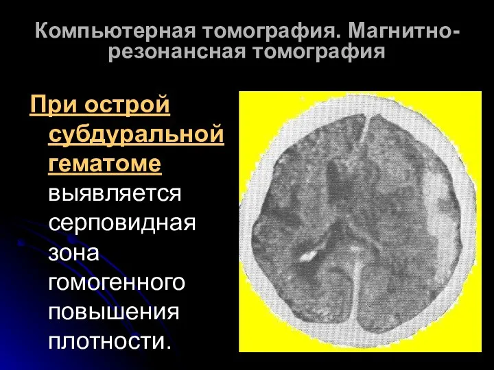 Компьютерная томография. Магнитно-резонансная томография При острой субдуральной гематоме выявляется серповидная зона гомогенного повышения плотности.